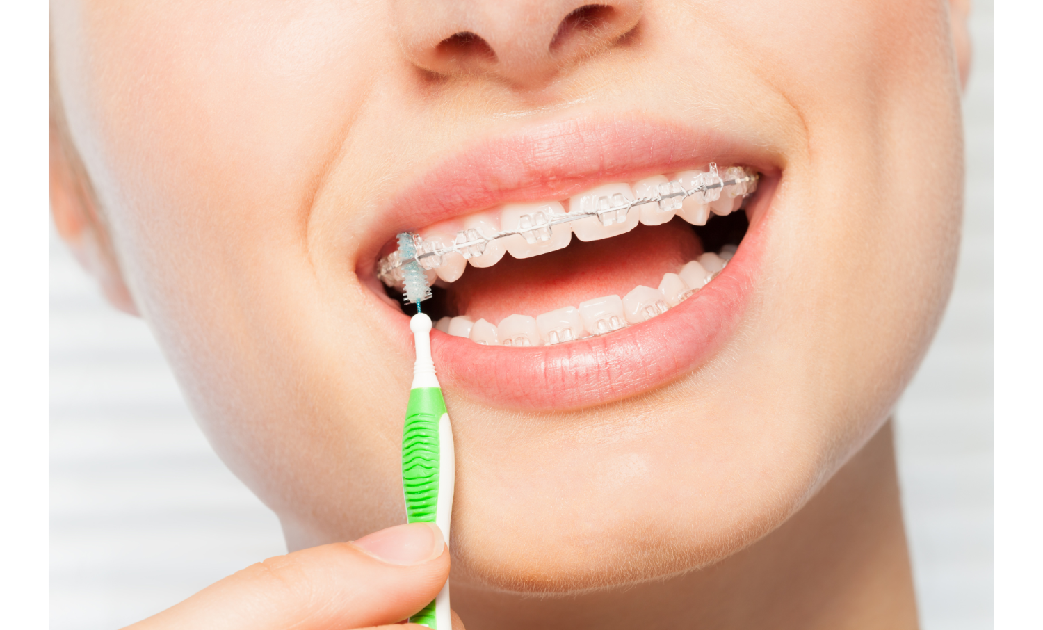 小児矯正から成人矯正まで承ります