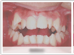 発音や食事の際の咀嚼に影響を及ぼします