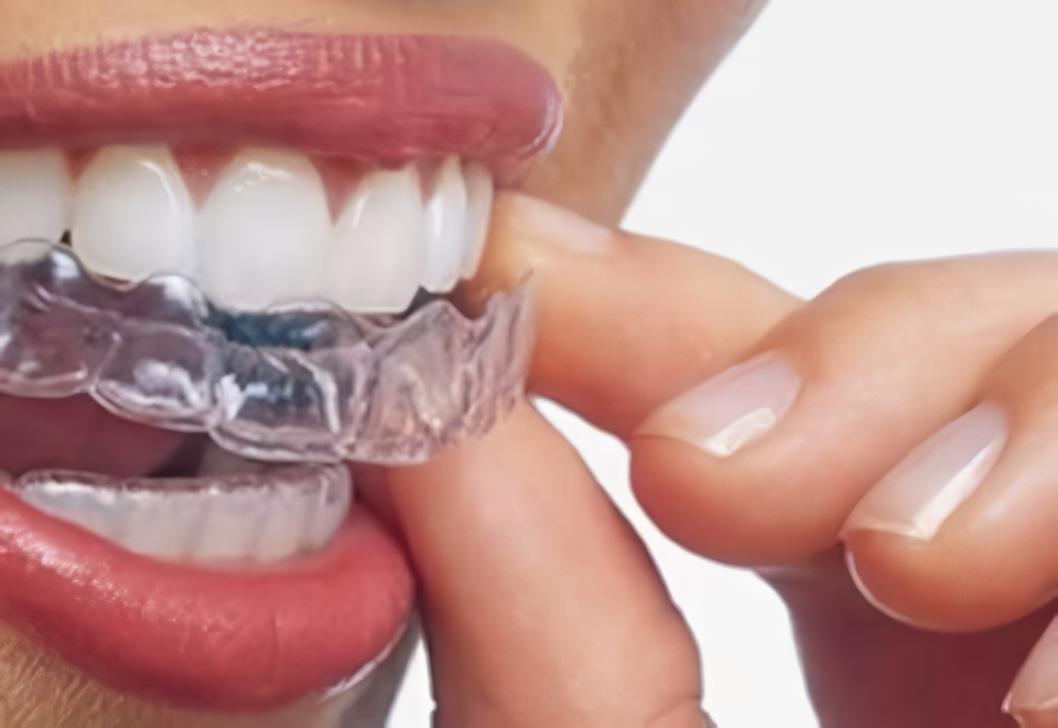 透明マウスピースで目立たない矯正治療と快適な口腔衛生管理を実現