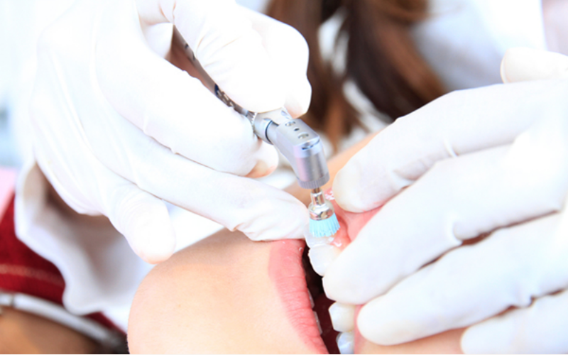 専用の器具で歯垢や汚れを取り除く歯のクリーニングPMTC