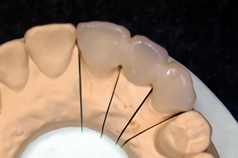 オールセラミック