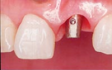 失った歯の機能回復を目指す治療の中でも、インプラント治療に力を入れています