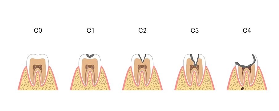 お口の中の細菌が増えることで全身の健康にも関わるため、早期発見と早期治療が大切です。