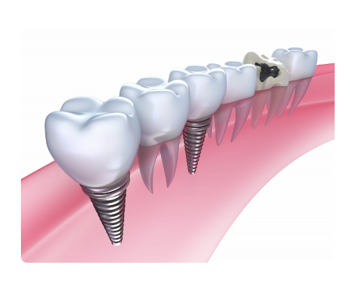 インプラントは、天然歯に近い見た目と機能を兼ね備えている点が特長です