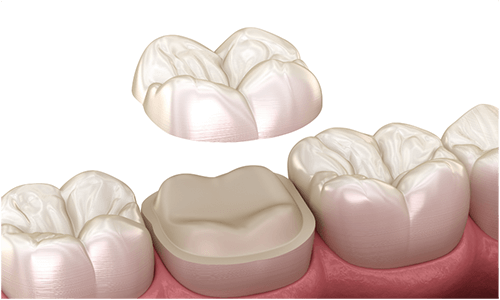 患者様に最適なつめ物やかぶせ物をご提案しています