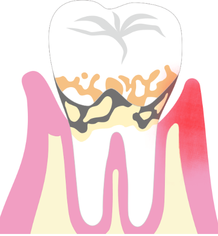 歯を失う前に予防しましょう