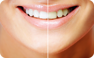 歯を削ることなく、白く美しくする方法