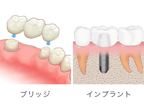 他の歯に負担をかけない理想的な治療選択