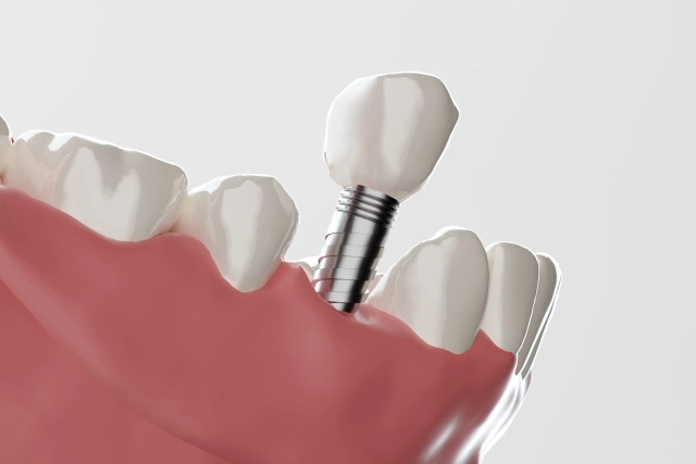 歯科用CTによる精密な事前検査を実施しています