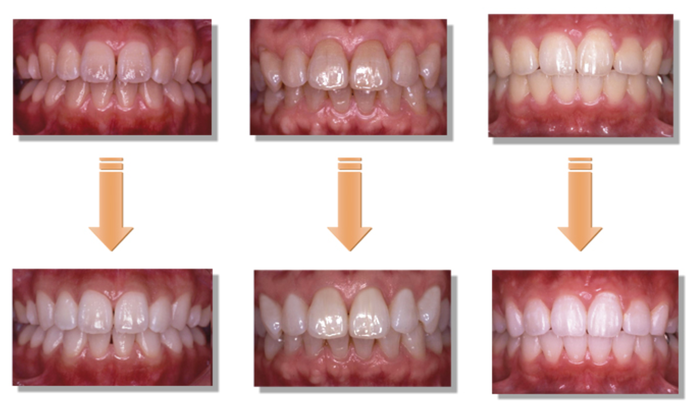 白く輝く歯は自信にも繋がります