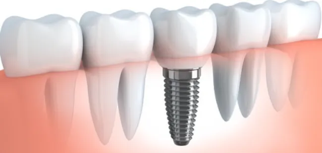 歯を失った患者様が再びしっかり噛めるようになるためのインプラント治療に対応しています。