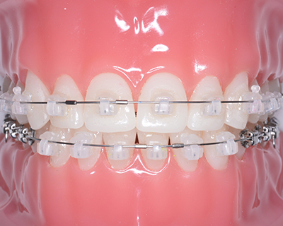 美しい歯並びを短期間で