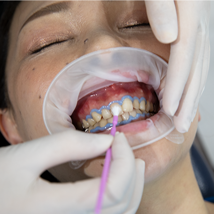 オフィスホワイトニング