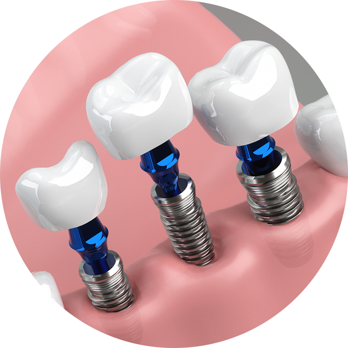 「気づいたら終わってた」安心麻酔のインプラント手術