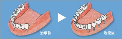 インプラントのイメージ