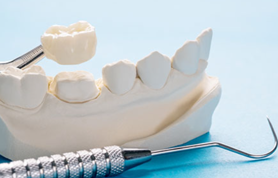 セラミック治療で、自信の持てる口元を叶えましょう