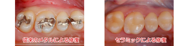 セレック治療に興味をお持ちの方は、ぜひ林歯科医院にご相談ください