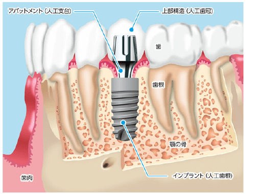 インプラント専門医が治療に臨みます