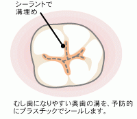 シーラント（予防充塡）