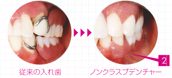 目立たない入れ歯「ノンクラスプデンチャー」
