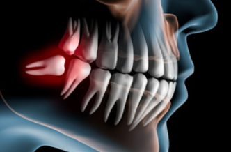患者様のお体への負担が少ない親知らずの抜歯を行っております