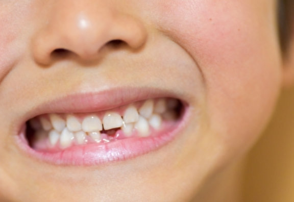 フッ素塗布とシーラントで子どもの健やかな口腔発達をサポート