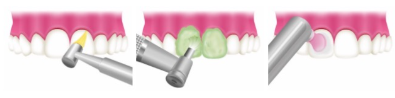 歯科衛生士によるPMTC