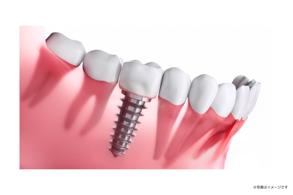 顎の骨の状態や神経の位置を正確に把握したうえで、患者様一人ひとりに合った治療計画が立てられています