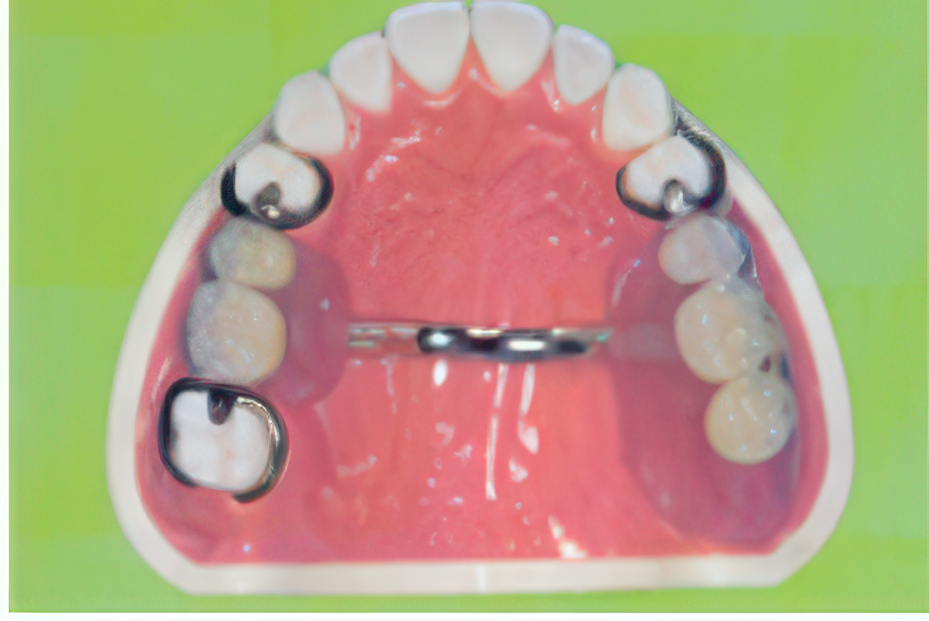 パーシャルデンチャーの症例