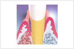 歯周ポケットの確認を行います