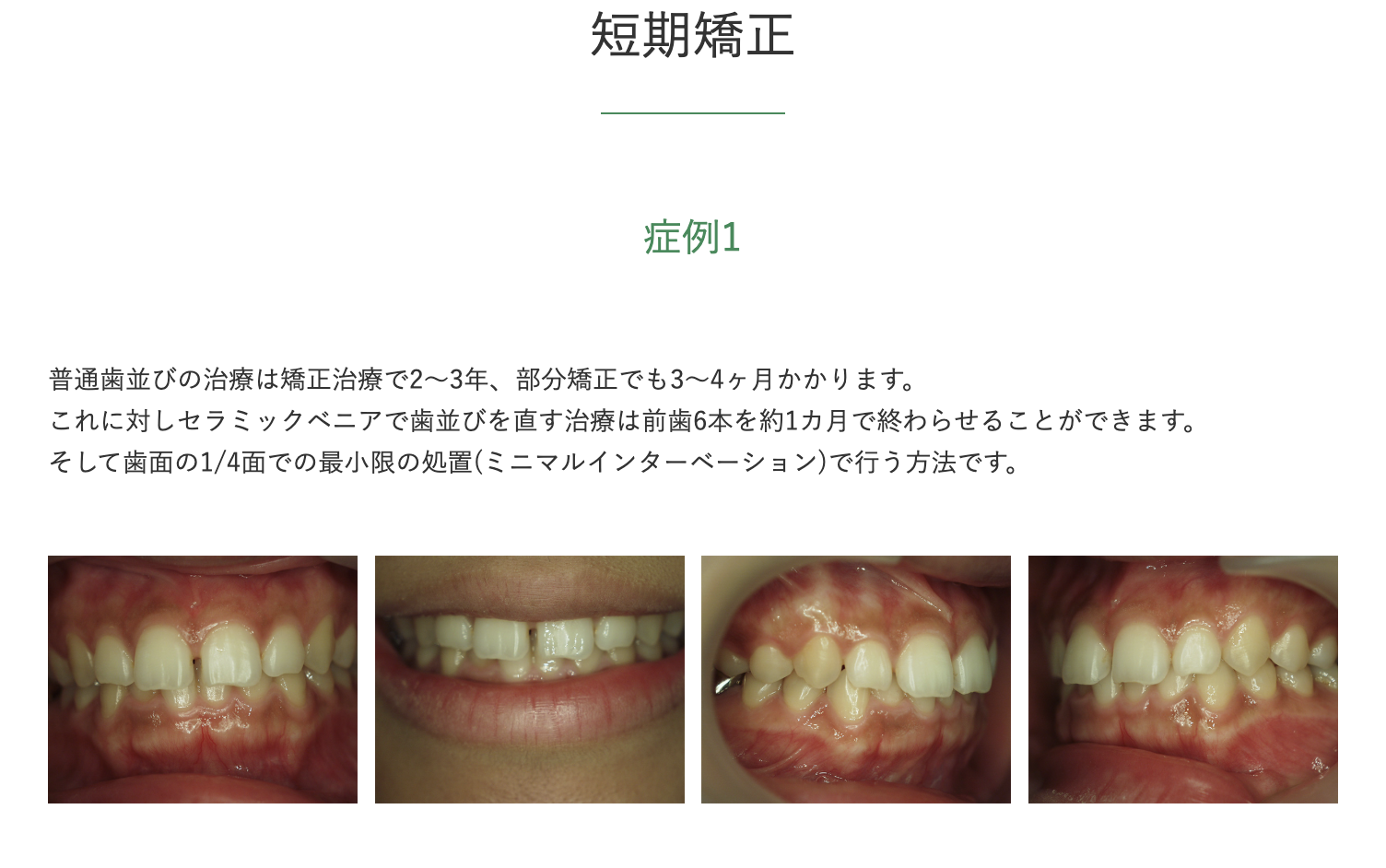 目立ちにくく短期間で完了する治療法を採用しています