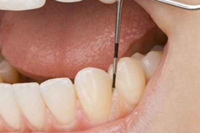 歯みがきだけでは取り除けない汚れも専用の器具で綺麗にします