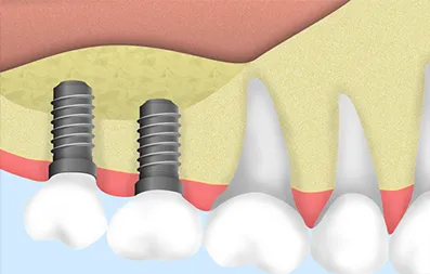 失った歯を自然に再現します
