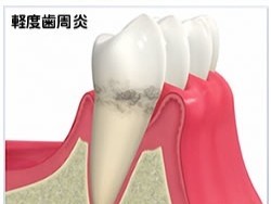 お口の清掃状態を清潔に保つことを治療の基本としています