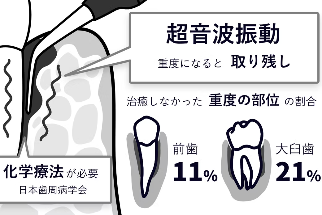 歯周ポケット内の細菌減少を図っています
