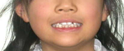 お子様の未来のために、適切なタイミングで治療を行い、最良の結果を目指しましょう。