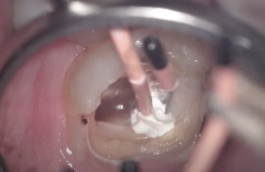 拡大鏡やマイクロスコープを駆使した精密拡大治療を実践しています