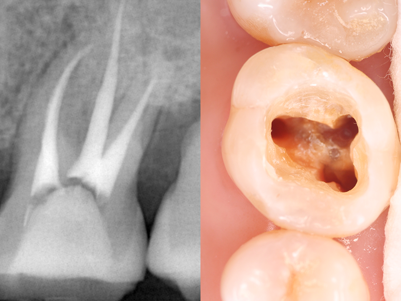 歯を抜かずに残すことが可能です