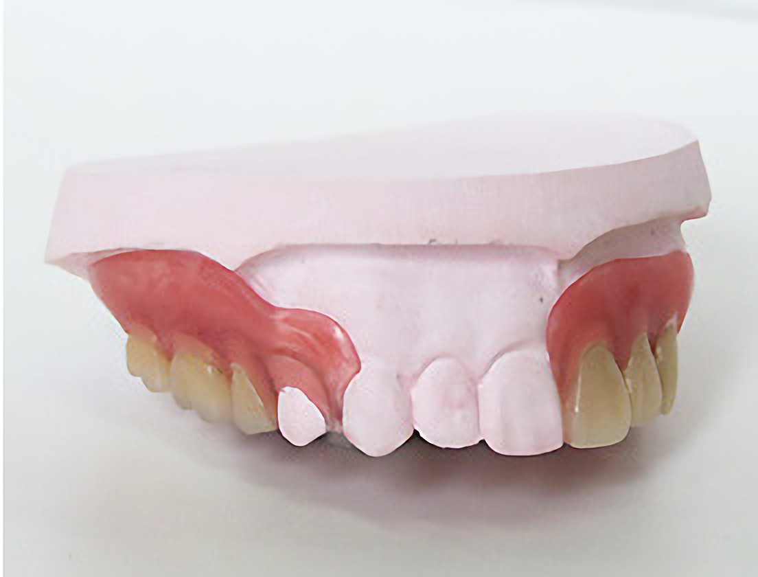 ノンクラスプ床義歯