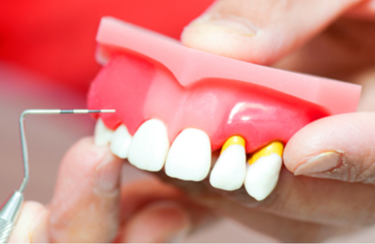 虫歯や歯周病にならない・再発防止の為には、定期的な歯科検診をおすすめします。