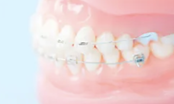 矯正治療の無料相談を行っています