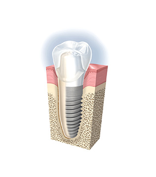 患者様のケアによって、インプラントは長期間使用可能で、快適な口腔環境を維持できます。