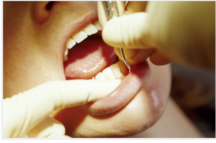 歯周病になっても初期段階で抑えられるようにしましょう