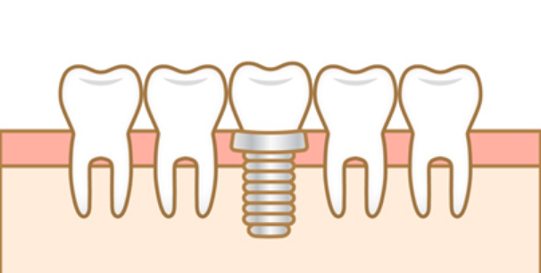 濱本歯科・口腔外科クリニックのインプラント治療—自然な機能と美しさを取り戻す
