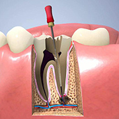 顕微鏡を用いて見落としなく治療を行います