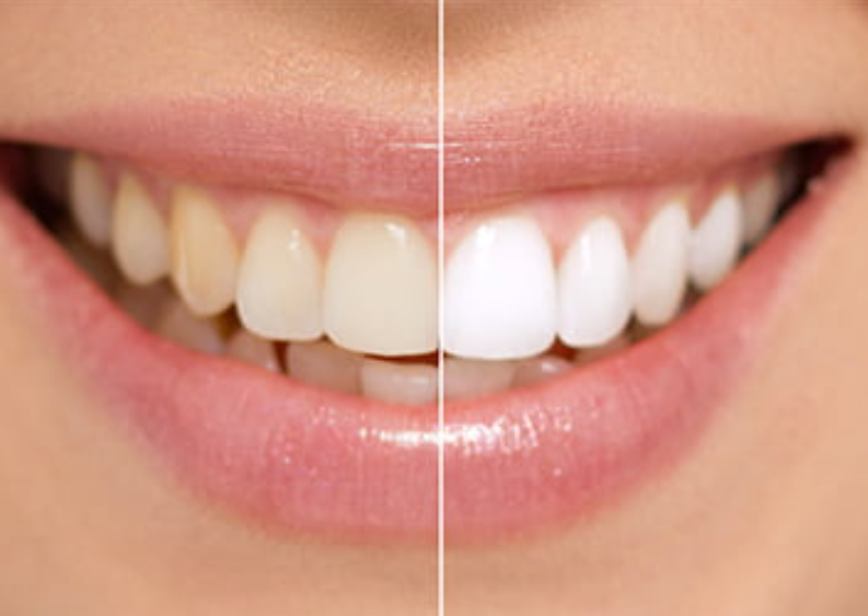 確かな技術で美しい白い歯を実現