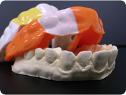 マウスガードでお口を守ります