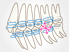 「なるべく抜かずに早くきれいに治療する」をモットーに、患者様に無理のない方法で矯正治療を提供しています