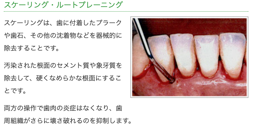 日常のブラッシングでは届かない部分の汚れや着色を丁寧に取り除きます