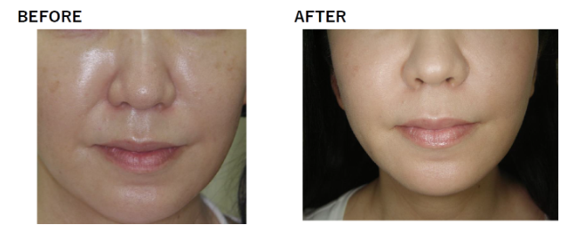 ほうれい線の改善例